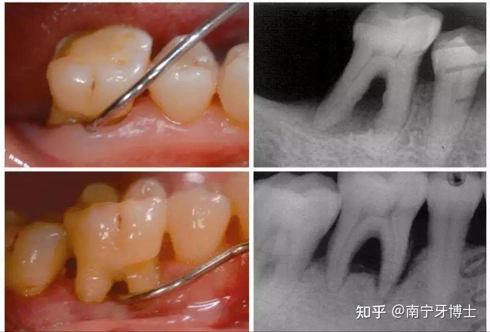 3,重度牙周炎——牙周翻瓣术如果靠洁牙,龈下刮治都无法控制炎症的