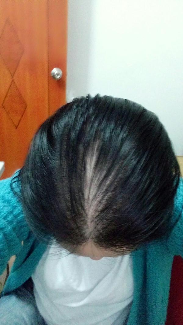 本人女,26岁,头发又细又油,头顶头发很稀疏,有没有人得了脂溢性脱发治