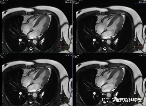 图18:临床场景的4ch图像,标准的横轴位