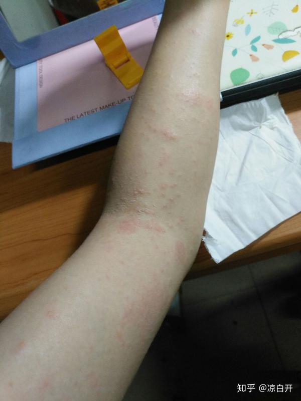 螨虫严重过敏是种怎样的体验?