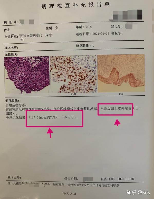 高危hpv感染到宫颈原位癌～姐妹,这篇宫颈癌前病变就诊实录你必须看!