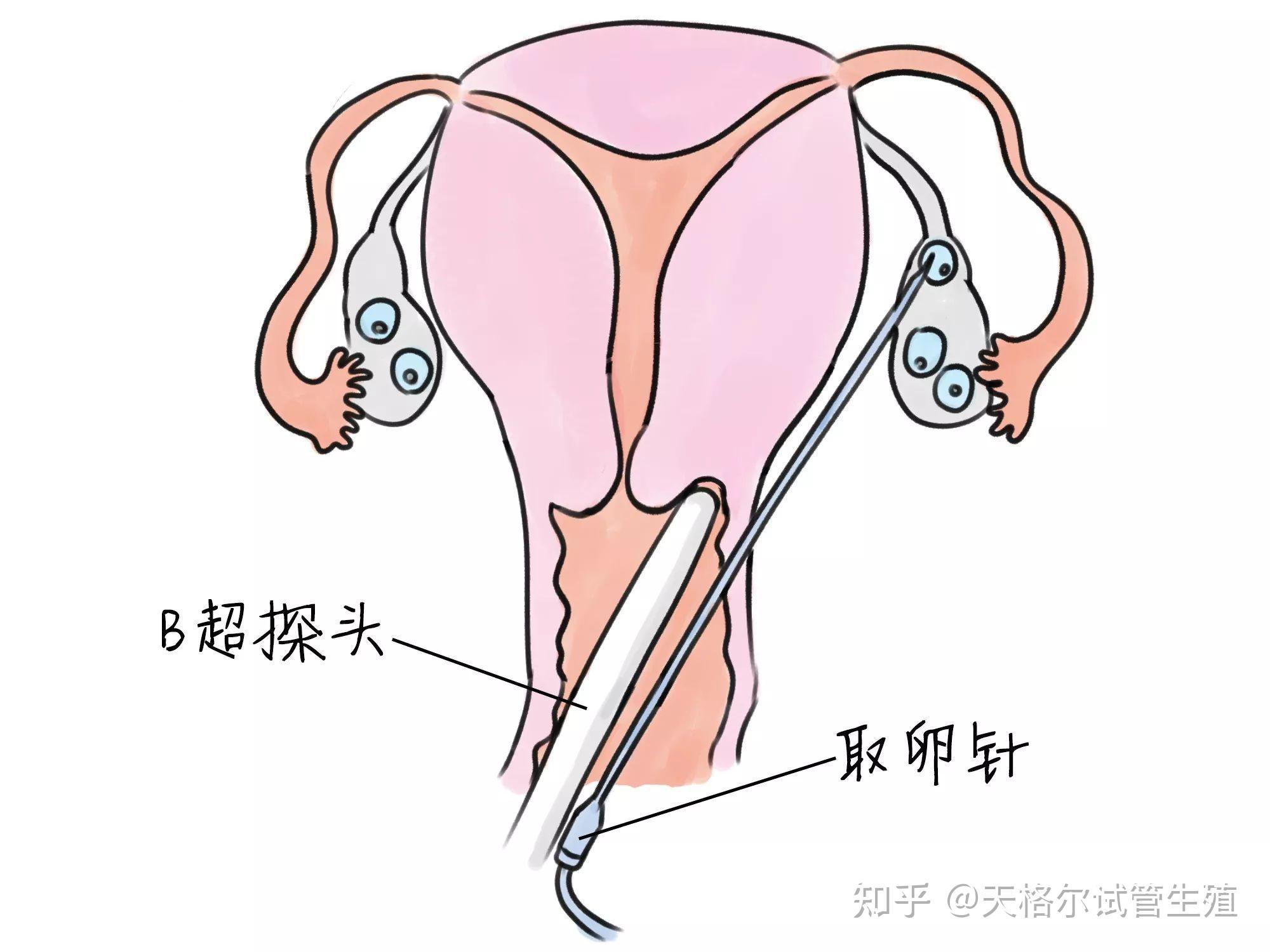 针,在b超坚持下,经阴道壁到达卵巢内取卵.