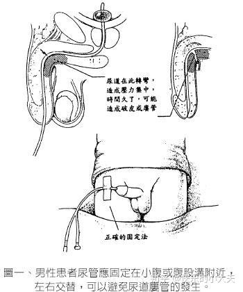 7,在离床活动时,应用胶布将导尿管远端固定法在大腿上,以防尿管脱出.