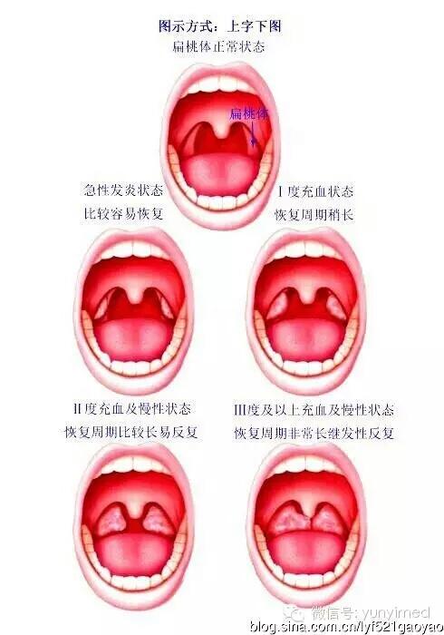 儿童扁桃体与腺样体手术方式选择