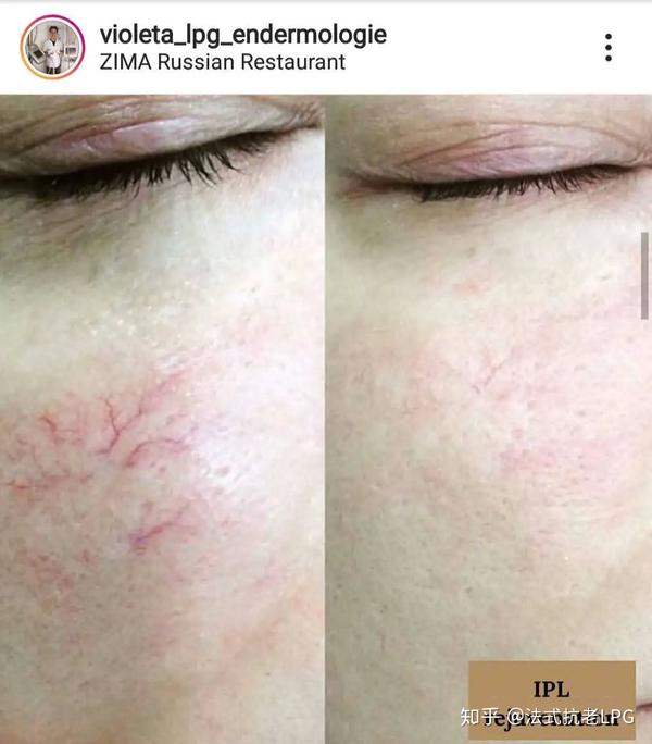 腿部的橘皮现象很严重,很大一部分的女性表示想要改变身上受橘皮组织