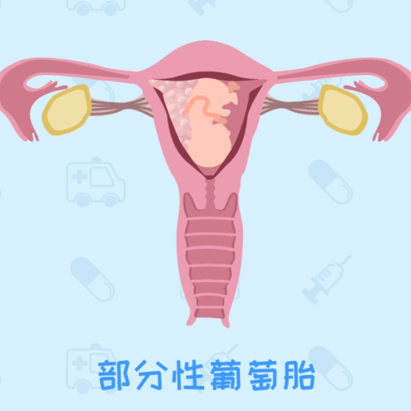 可她沉浸怀孕喜悦没多久,就发现有少量出血.