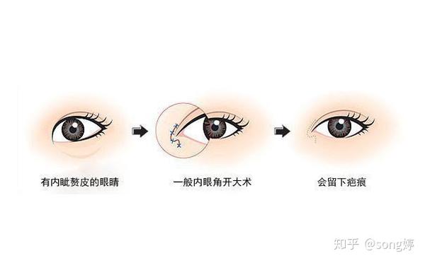 中重度内眦赘皮者; 先天性小眼症患者; 眼睛比较小希望通过手术进行