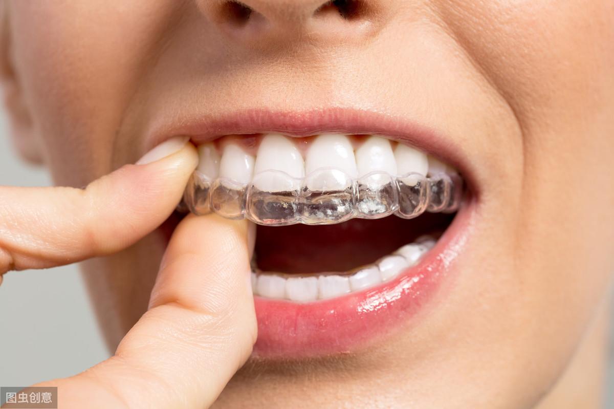 材质揭秘:隐形牙套像"塑料",效果和"钢牙"比怎么样?