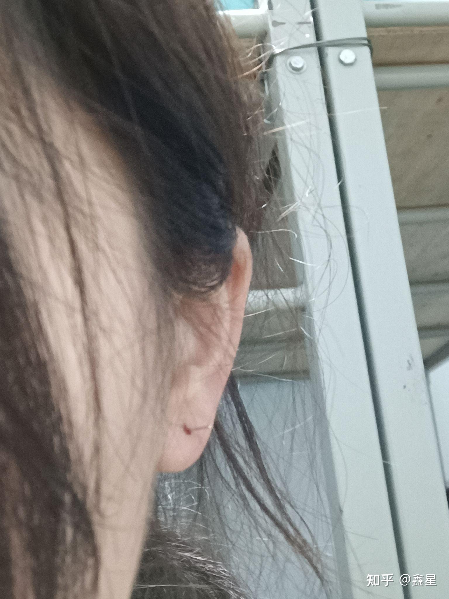 耳洞结痂戴不进耳钉怎么办