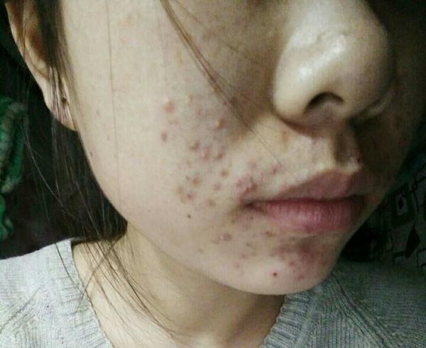 高中青春期满脸痘 让我很自卑 共勉