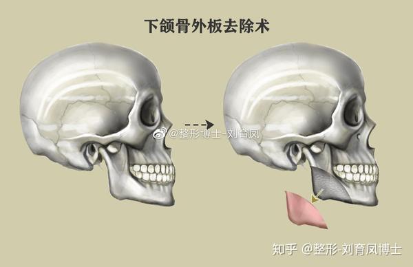 关于下颌角几种截骨方式的选择