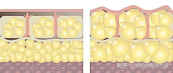 腹部腋下的脂肪颗粒到底长什么样子