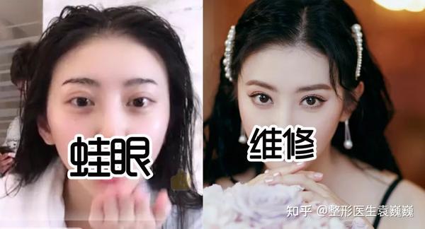 为什么眼球凸的人不建议做宽双眼皮?