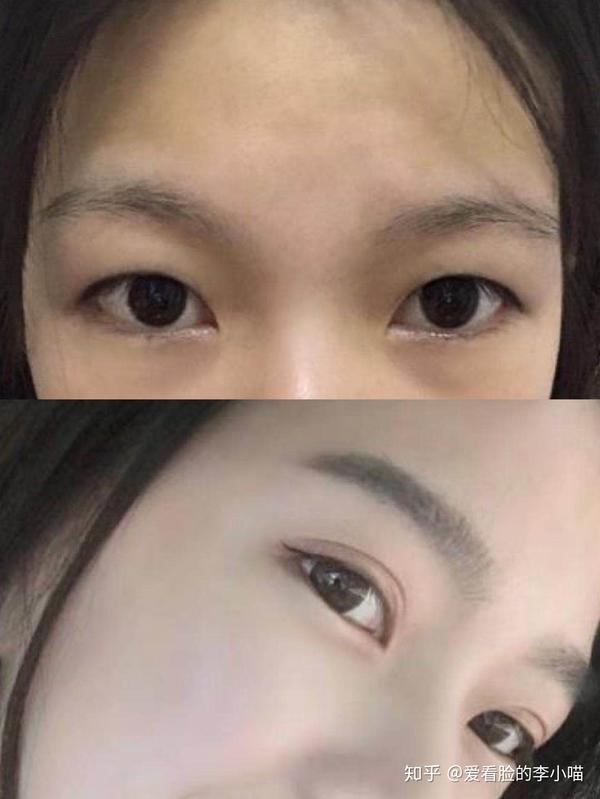 我在北京做的双眼皮超级自然!闭上眼睛都看不到疤痕感真的绝了!