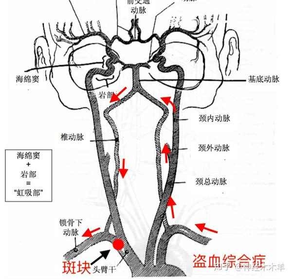 行右锁骨下动脉狭窄球囊扩张,但效果不明显,盗血未有改善.