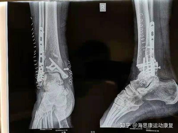            【常规踝关节骨折术后