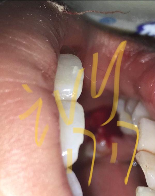 血牙有点高,流血就 很多很多 建议大家早上拔牙
