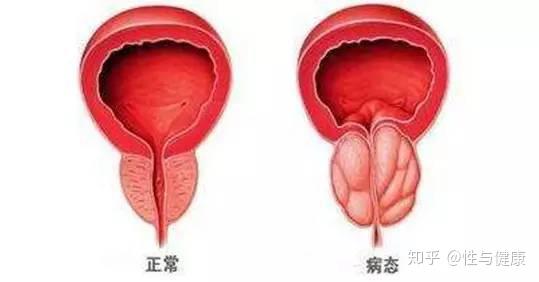 前列腺炎的自我诊断和危害,预防治疗