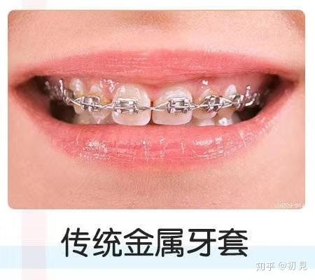 传统矫正: 1,普通金属牙套:包括金属的和陶瓷的两种,普通托槽是粘在