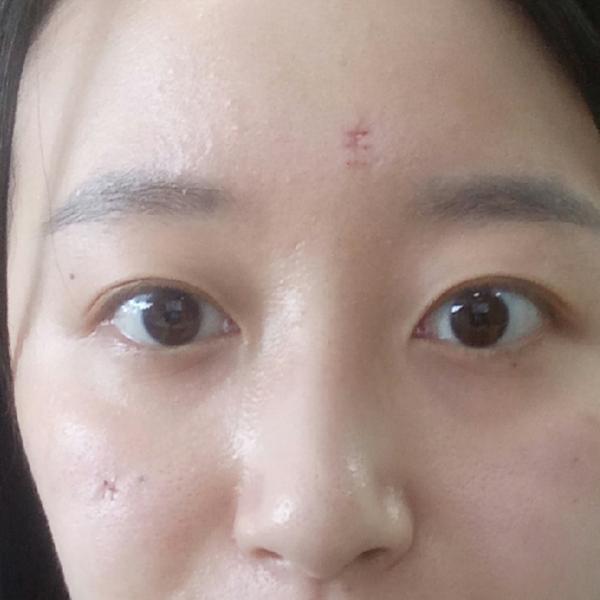手术切痣是一种怎样的体验?