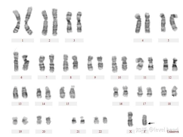 臂间倒位-是个位点属于多态性改变)46,xx,21ps 21号染色体短臂随体