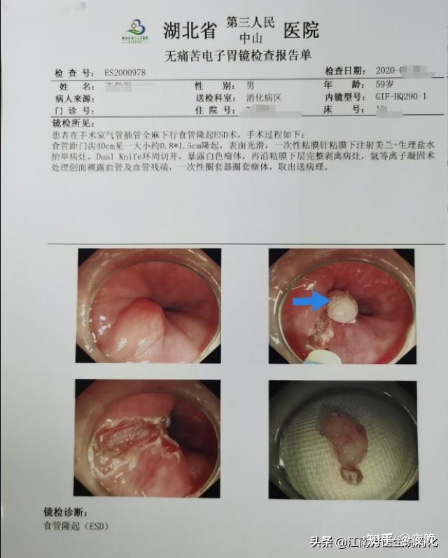 平滑肌瘤一般长在哪个位置(食管上长的这个平滑肌瘤要