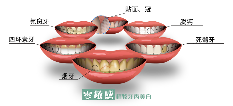 各种类型的牙齿染色