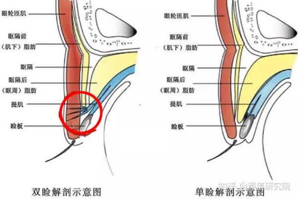 所以双眼皮手术,就是要人为将上睑提肌和眼轮匝肌通过缝合线连接在一