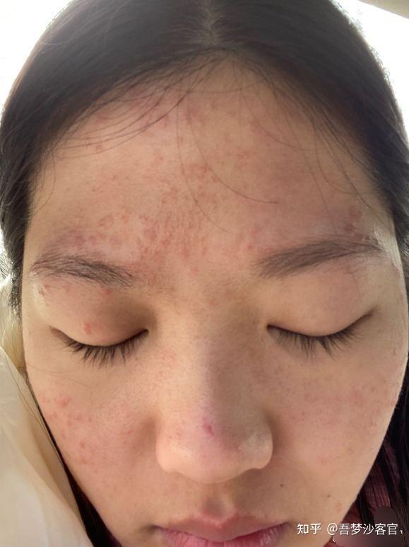 脸上的扁平疣会自然脱落吗