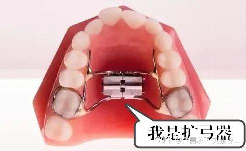 不拔牙矫正 扩弓就是用扩弓器把牙弓扩大,让每一颗牙齿都能有自己的