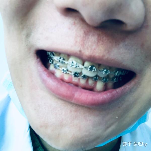 戴过牙套(矫正牙齿)的人脸型变了吗?
