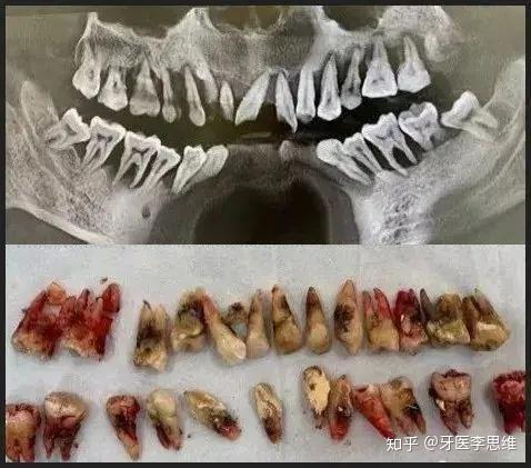 30多岁的小伙子因牙齿松动就诊结果全口牙齿都要拔掉