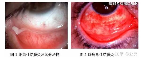 科普| 正确分析疫情下的结膜炎!