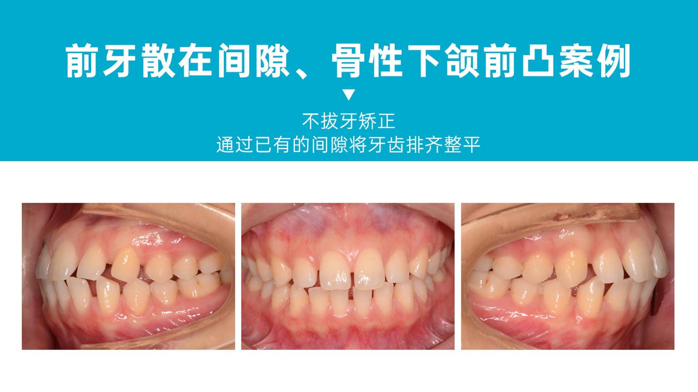 广州隐形矫正前牙散在间隙骨性下颌前凸正畸案例