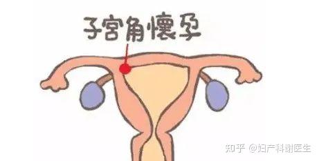 胚胎着床在宫角还能不能要