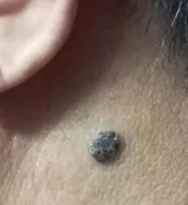 男,37岁,右胳膊臂弯处有一颗大约5毫米的凸起黑痣.