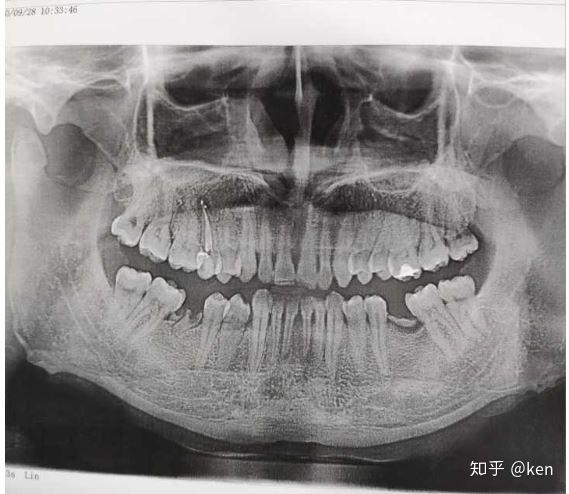 记广州根管治疗以及拔智齿的经历