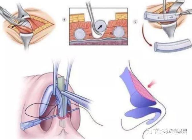 舒铂超肋鼻材料做鼻子效果怎么样跟肋骨鼻相比哪个好