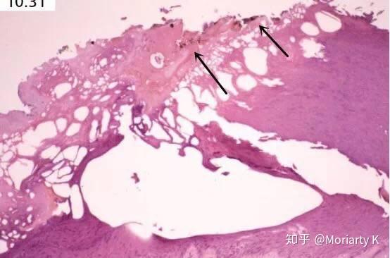 黑色箭头所示电流斑处皮肤表面黑褐色颗粒即为带电导体的金属颗粒沉积