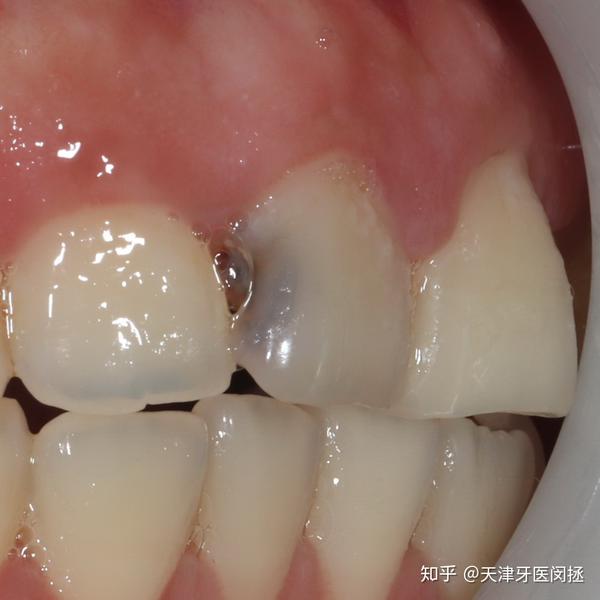 龋齿分几种?应该怎么治疗?