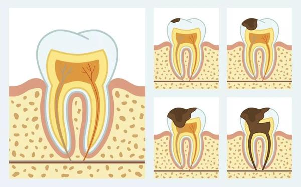 龋齿到牙髓炎的发展过程