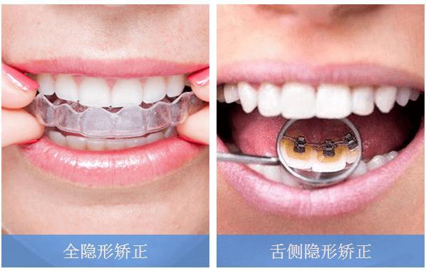 上海舌侧牙齿矫正|舌侧正畸值得做吗?效果真的如传言那么好吗?