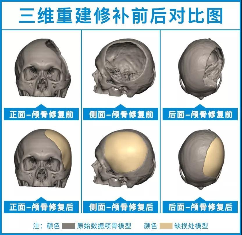 颅骨缺损该不该补意外摔伤后重症患者颅骨缺损患者是如何康复的