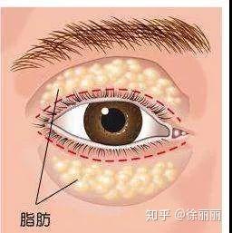 肿眼泡,又叫肉泡眼,水泡眼,一般是由于先天或衰老,眶隔松弛,眶内脂肪