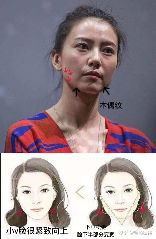 颊脂垫的下垂,总结来讲会导致出现,木偶纹,下颌线不清晰,有双下巴