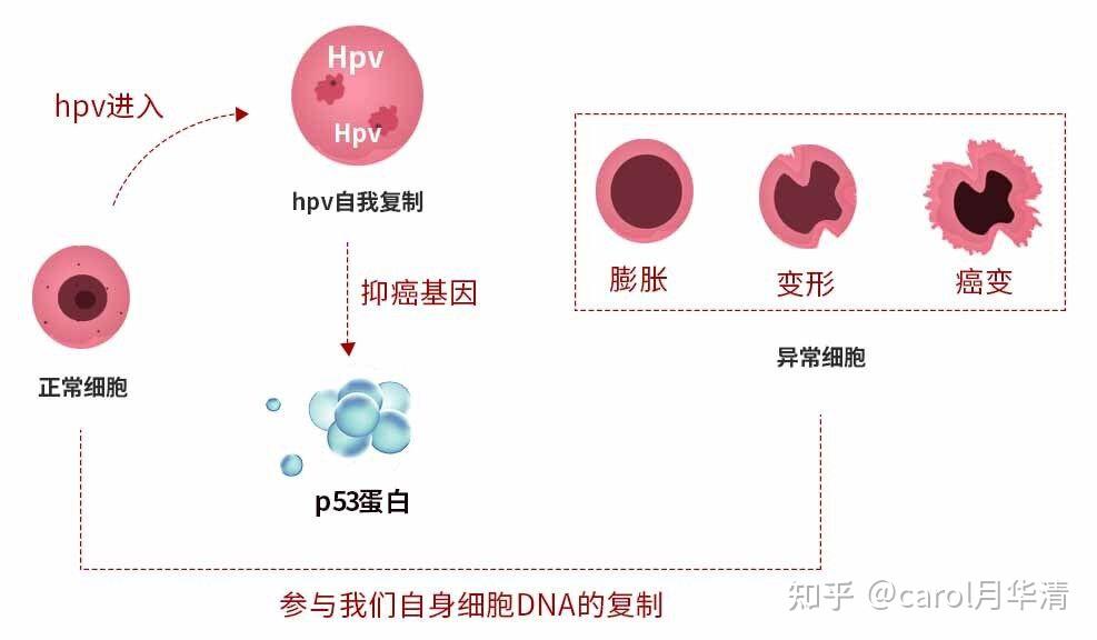 cin1是炎症还是癌变cin1级需要做利普刀吗