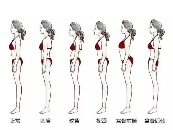 盆骨前倾显肚大盆骨后倾屁股塌讲透两个体态纠正方法进来领