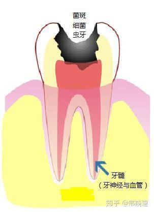 蛀牙导致牙齿龋洞很深怎么治疗的