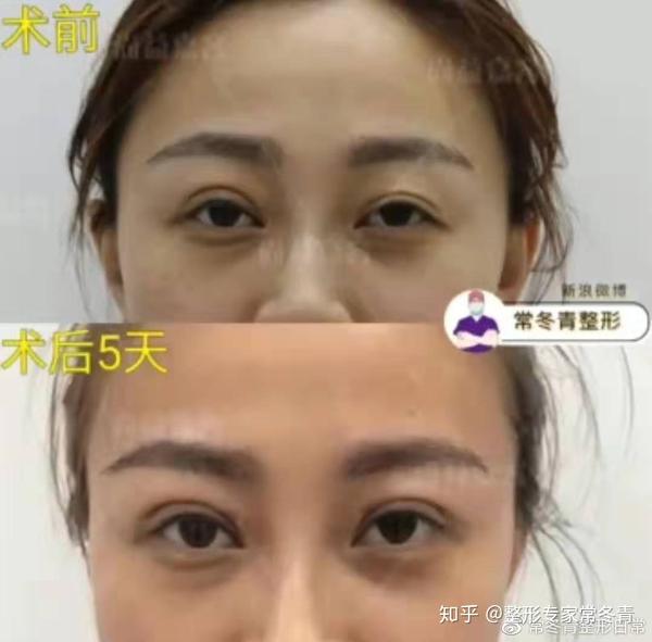 眼皮松弛和上睑下垂,有什么区别?