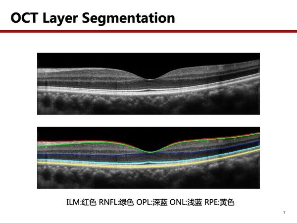 oct视网膜分层demo